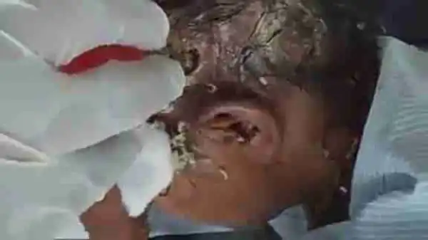 Maggots Coming Out From A Woman